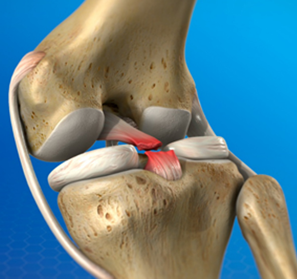 LCP el dolor detrás de la rodilla